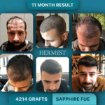 Hair Transplant Clinics in Turkey