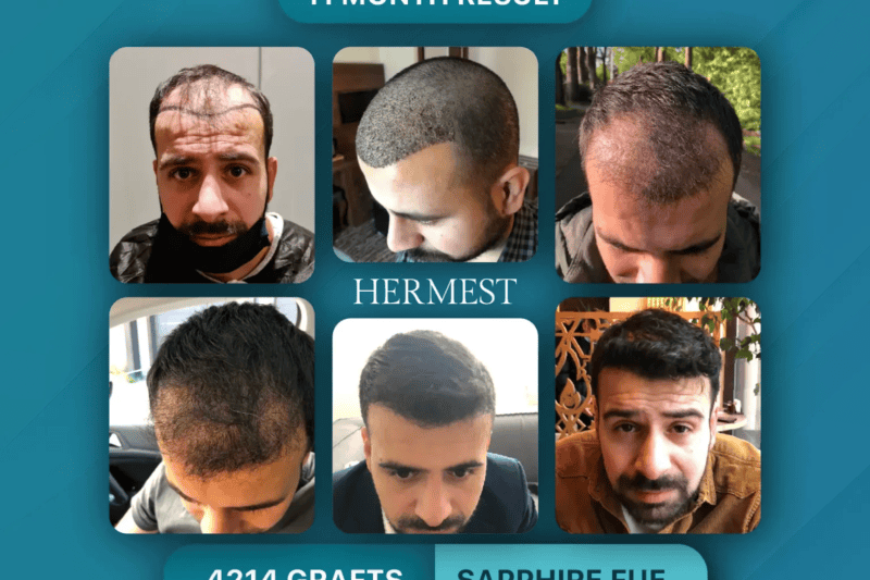 The Best Hair Transplant Clinics in Turkey in 2026: What Every Top Ranking Has in Common